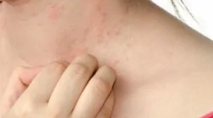 Kako se riješiti šuga: metode liječenja